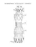 VASCULAR PROSTHESIS FOR TREATING ANEURYSMS diagram and image