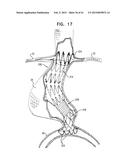 VASCULAR PROSTHESIS FOR TREATING ANEURYSMS diagram and image