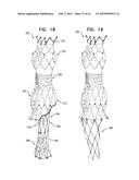 VASCULAR PROSTHESIS FOR TREATING ANEURYSMS diagram and image