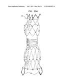 VASCULAR PROSTHESIS FOR TREATING ANEURYSMS diagram and image