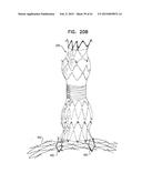 VASCULAR PROSTHESIS FOR TREATING ANEURYSMS diagram and image