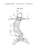 VASCULAR PROSTHESIS FOR TREATING ANEURYSMS diagram and image