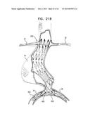 VASCULAR PROSTHESIS FOR TREATING ANEURYSMS diagram and image