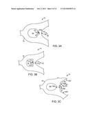 VARIABLE STIFFNESS STENT diagram and image