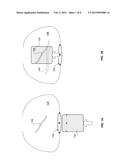 Expandable Surgical Implant Device diagram and image