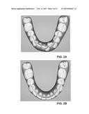 DENTAL POSITIONER diagram and image