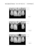 BIOCOMPATIBLE MATERIAL BARS APT TO PREVENT THE INTERDENTAL BONE PEAK     RESORPTION FOLLOWING DENTAL PROCEDURES AND / OR PERIODONTAL DISEASES diagram and image