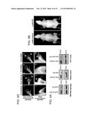 Hedgehog Pathway Inhibition for Cartilage Tumor and Metachondromatosis     Treatment diagram and image