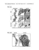 Hedgehog Pathway Inhibition for Cartilage Tumor and Metachondromatosis     Treatment diagram and image