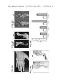 Hedgehog Pathway Inhibition for Cartilage Tumor and Metachondromatosis     Treatment diagram and image