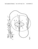 METHOD AND APPARATUS FOR INFLATING AND DEFLATING BALLOON CATHETERS diagram and image