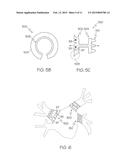 IMPLANT DEVICE WITH SPINE AND C-RING AND METHOD OF MAKING, DELIVERING, AND     USING SAME diagram and image