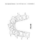 MACHINED SURGICAL GUIDE diagram and image