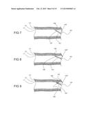 TISSUE EXPANSION DEVICES, SYSTEMS AND METHODS diagram and image