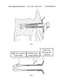 UNIVERSAL ANCHOR FOR BONE FIXATION diagram and image