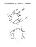 UNIVERSAL ANCHOR FOR BONE FIXATION diagram and image