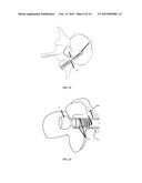 UNIVERSAL ANCHOR FOR BONE FIXATION diagram and image