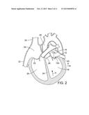 METHOD AND APPARATUS FOR RESHAPING A VENTRICLE diagram and image