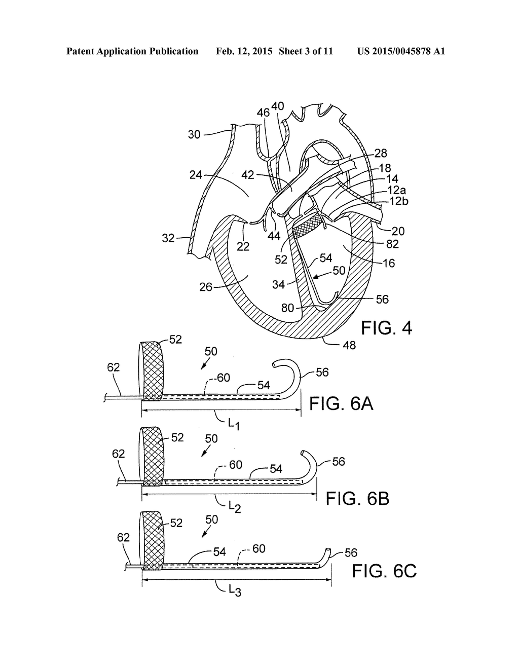 METHOD AND APPARATUS FOR RESHAPING A VENTRICLE - diagram, schematic, and image 04