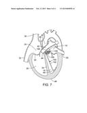 METHOD AND APPARATUS FOR RESHAPING A VENTRICLE diagram and image