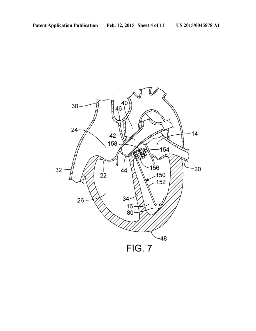 METHOD AND APPARATUS FOR RESHAPING A VENTRICLE - diagram, schematic, and image 05