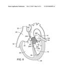 METHOD AND APPARATUS FOR RESHAPING A VENTRICLE diagram and image