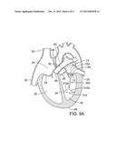 METHOD AND APPARATUS FOR RESHAPING A VENTRICLE diagram and image