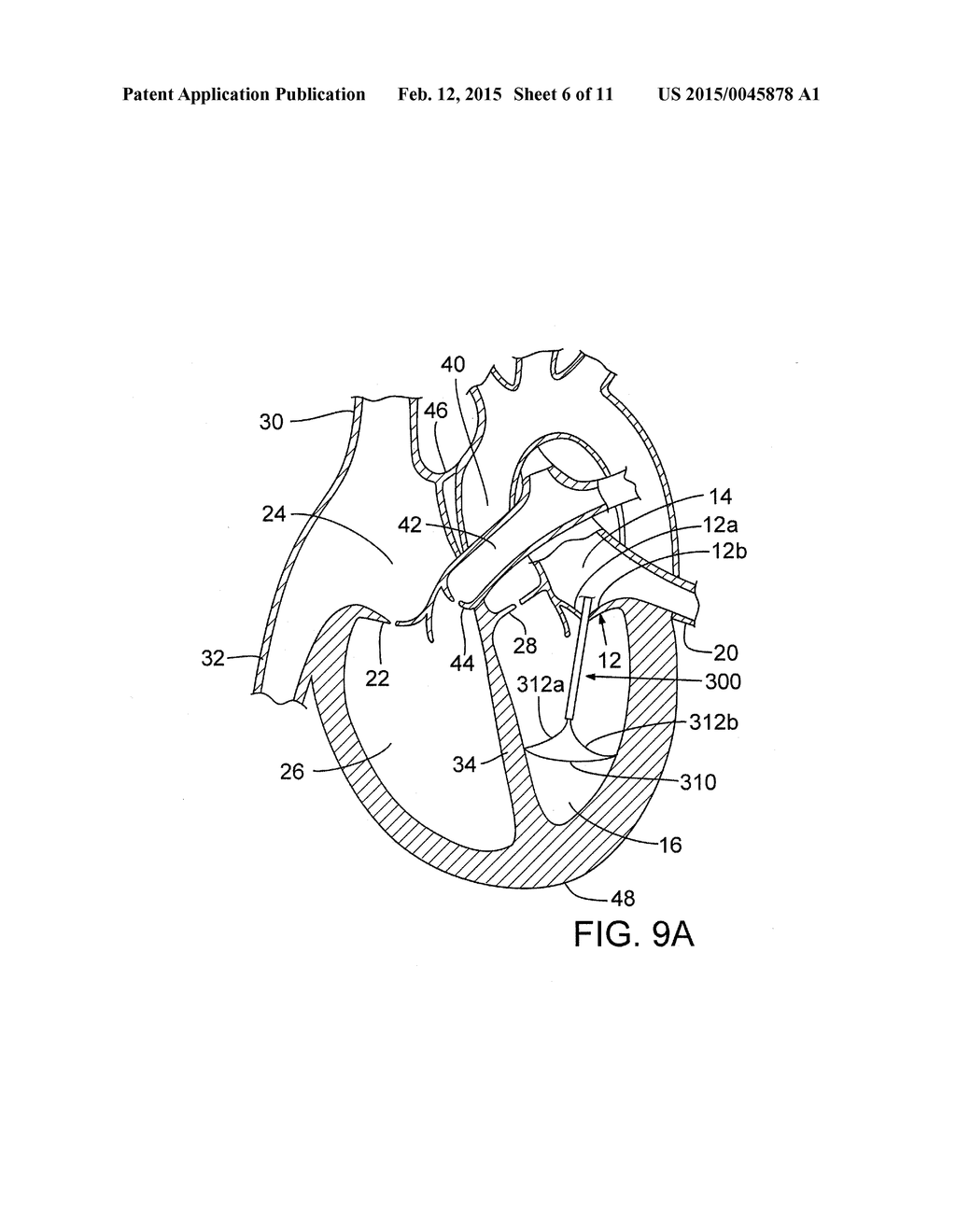 METHOD AND APPARATUS FOR RESHAPING A VENTRICLE - diagram, schematic, and image 07