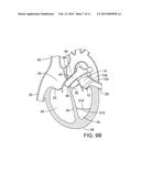 METHOD AND APPARATUS FOR RESHAPING A VENTRICLE diagram and image