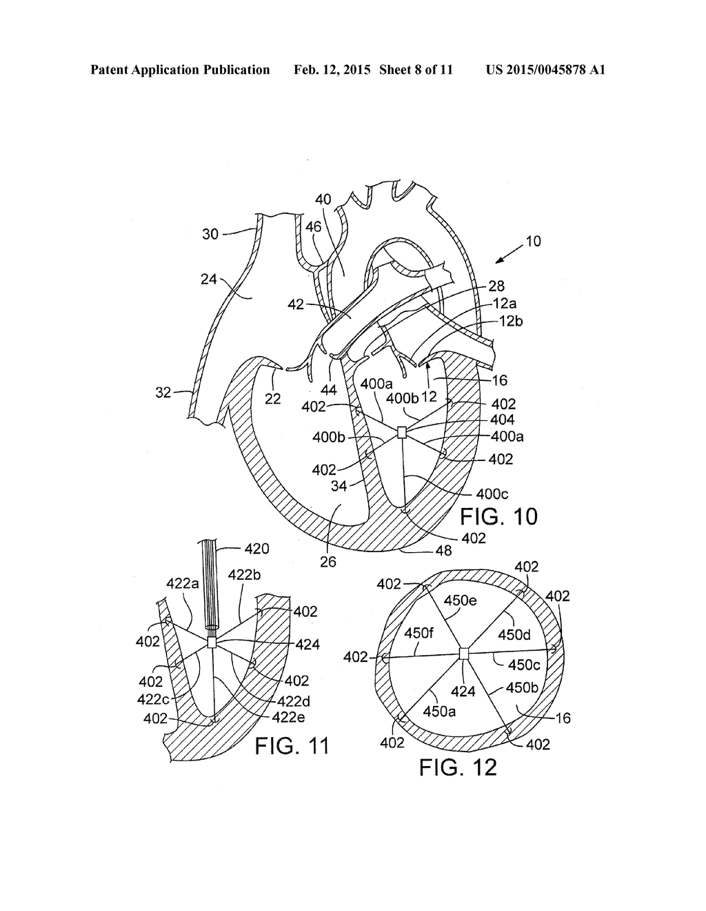 METHOD AND APPARATUS FOR RESHAPING A VENTRICLE - diagram, schematic, and image 09