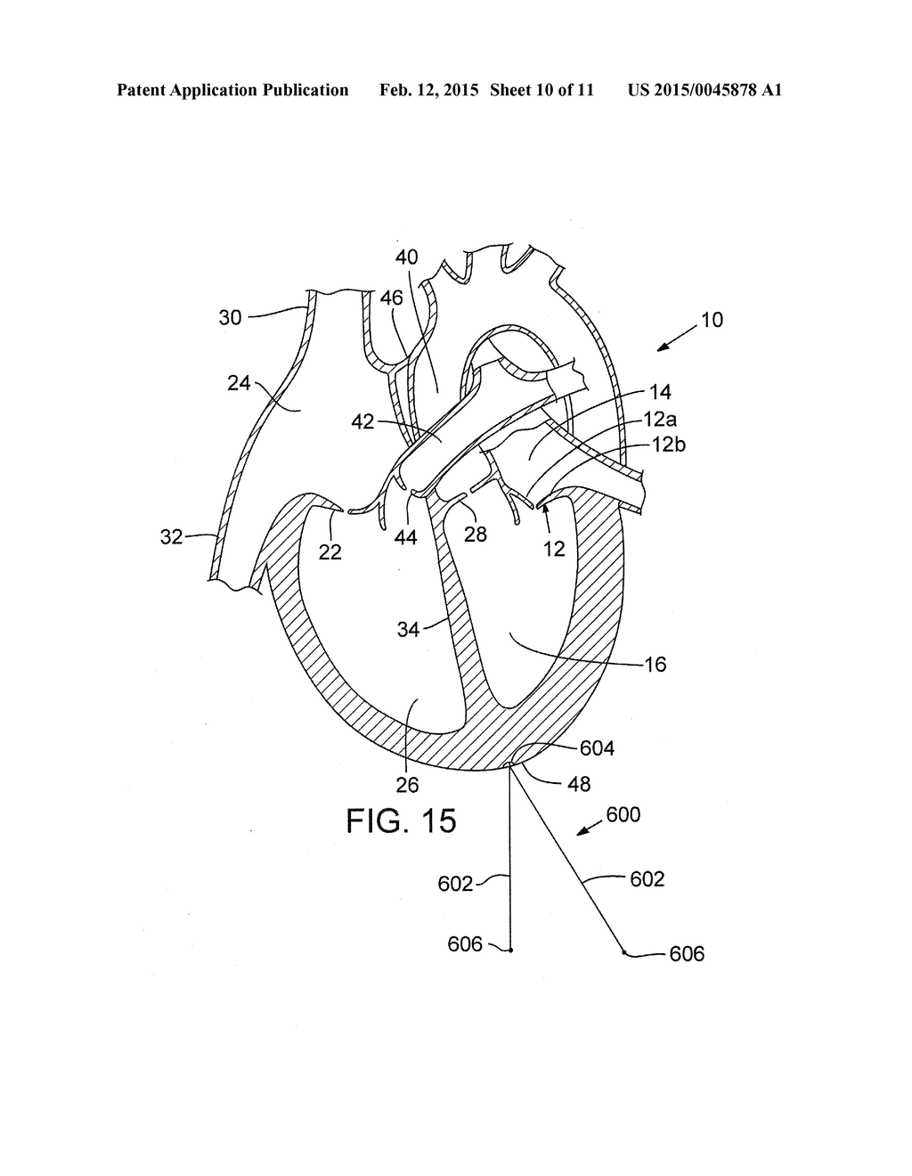 METHOD AND APPARATUS FOR RESHAPING A VENTRICLE - diagram, schematic, and image 11