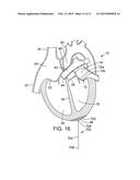 METHOD AND APPARATUS FOR RESHAPING A VENTRICLE diagram and image