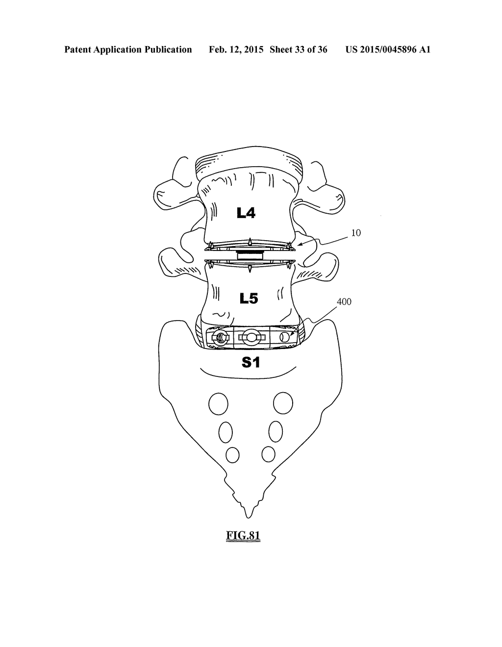 TOTAL DISC REPLACEMENT SYSTEM AND RELATED METHODS - diagram, schematic, and image 34