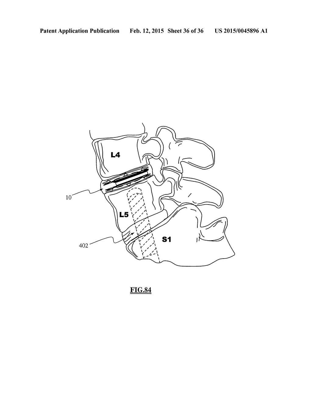 TOTAL DISC REPLACEMENT SYSTEM AND RELATED METHODS - diagram, schematic, and image 37