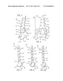 System and Method for Fracture Replacement of Comminuted Bone Fractures or     Portions Thereof Adjacent Bone Joints diagram and image