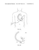 VENTRICULAR ASSIST SYSTEM diagram and image