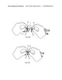 EXTENSIONLESS REVERSIBLE CONNECTION CATHETER APPARATUS diagram and image