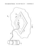 MANUALLY-ACTUATED REDUCED PRESSURE TREATMENT SYSTEM HAVING REGULATED     PRESSURE CAPABILITIES diagram and image