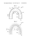 INTRA-ORAL DEVICE FOR TREATING OBESITY diagram and image