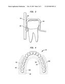 INTRA-ORAL DEVICE FOR TREATING OBESITY diagram and image