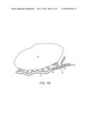 OVARIAN NEUROMODULATION AND ASSOCIATED SYSTEMS AND METHODS diagram and image