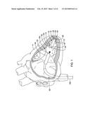 LEADLESS CARDIAC PACEMAKER AND RETRIEVAL DEVICE diagram and image