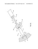 LEADLESS CARDIAC PACEMAKER AND RETRIEVAL DEVICE diagram and image