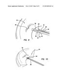 ARTHROSCOPIC MENISCAL REPAIR SYSTEMS AND METHODS diagram and image