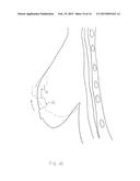 METHODS OF BREAST SURGERY diagram and image