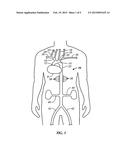 AORTIC OCCLUDER WITH STRENGTH BONDED BALLOONS diagram and image