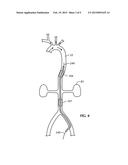 AORTIC OCCLUDER WITH STRENGTH BONDED BALLOONS diagram and image