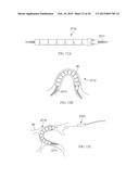 Torque Alleviating Intra-Airway Lung Volume Reduction Compressive Implant     Structures diagram and image