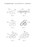 Torque Alleviating Intra-Airway Lung Volume Reduction Compressive Implant     Structures diagram and image