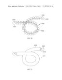 Torque Alleviating Intra-Airway Lung Volume Reduction Compressive Implant     Structures diagram and image